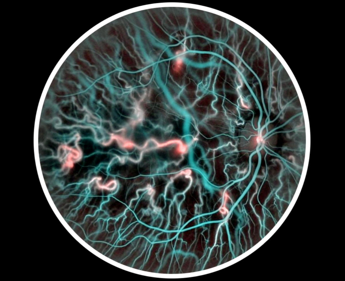 Doppler holography retinal blood-flow imaging